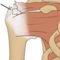 肩膀疼痛人群注意：肩膀疼不都是肩周炎，五個維度認識肩袖損傷