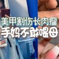 美甲割傷長肉瘤新手媽不敢喂母乳