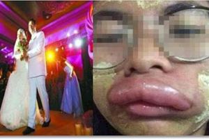泰國女孩嫁中國小夥，新婚第二天變香腸嘴，醫生的話讓他們很尷尬...
