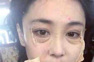 鍾麗緹臉上打針痕跡嚇人，張馨予臉上「蛻皮」讓人心疼，戚薇來救!