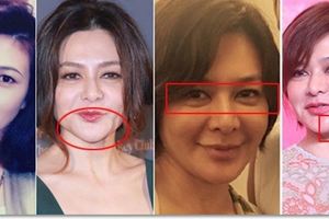這些明星的玻尿酸臉「崩塌了」，蕭亞軒面目全非，徐子珊像塑料臉！