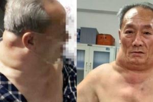 68歲老翁「脖子比腰還粗」身體畸形腫脹！醫生搖頭嘆「這個壞習慣造成的...」很多人都做過！