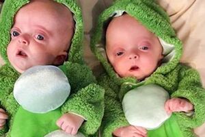 畸形雙胞胎出生4週被遺棄，老阿嬤無私收養，還說：看到孩子們歡笑，這一切很值得！