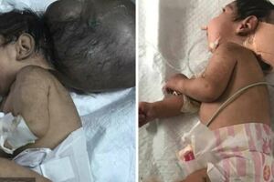 "雙頭"男嬰遭生父活埋路人救出送醫手術如今叔叔收養