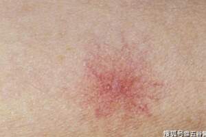 皮膚突然長出一些小紅點，是什麼？對身體有影響嗎？