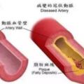 冬天如何保護血管多吃天然血管阿司匹林