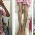 19歲腎衰竭，移植手術後又患重症胰腺炎，33.6公斤，骨瘦如柴的她與重症疾病的抗爭之路