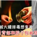 美女拔火罐排毒想變美結果背部和脖子慘被燒爛