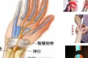 病患8塊腕骨已被「啃」了個半，竟是沖擊鑽惹的禍