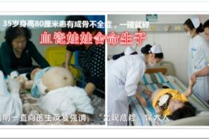 35歲身高80釐米熊貓血瓷娃娃捨命生子，醫生「孩子可能遺傳」