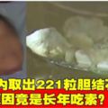 老婦體內取出221粒膽結石原因竟是長年吃素？