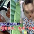 菲律賓幼兒腦積水手術後顱骨變形，變身「惡魔角」