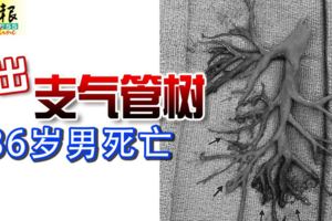 咳出支氣管樹36歲男死亡
