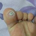 長雞眼該如何治療？