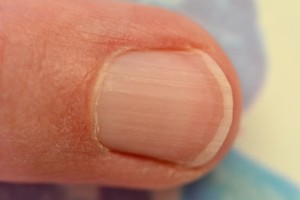 你的指甲上有一道道直線嗎？那你就要特別小心了！可能是這種重大疾病的微兆…