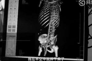 鋼筋從下體穿到後腦！男墜樓奇蹟生還