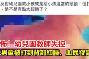 恐怖！幼兒園教師失控5歲男童被打到背部紅腫、血尿發高燒