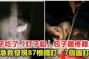 男子吃了「釘子餡」包子腹疼難忍！急救發現87根鐵釘、7個圖釘