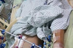 非法雇14歲童工墜樓重傷家屬控僱主說詞反覆推託