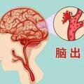 腦出血怎麼辦？醫生教你：學會這幾個急救方法能救你命