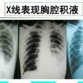 CT拍出來說胸腔有「積水」，是不是不好的病？