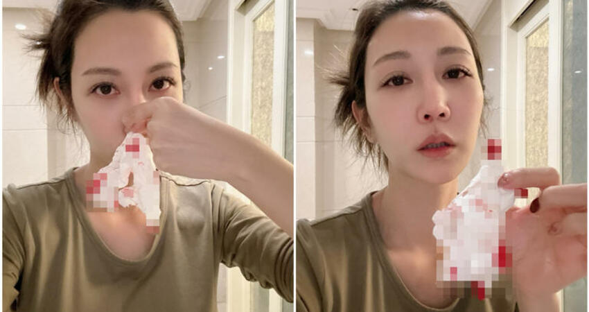 曾莞婷因1事爆鼻血！ 如何「正確止住」：好險我有看《影后》