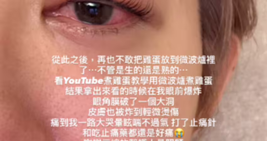 女星微波雞蛋變炸蛋！「角膜破大洞、皮膚燙傷」慘況曝光
