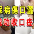 糖尿病傷口灑糖，竟成功收口痊癒？