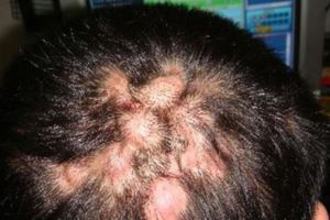 頭發中長了很多包，紅腫疼痛，頭發中長痘痘？如何區分是上火引起還是頭部毛囊炎？