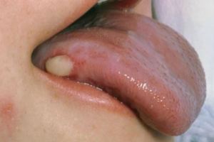 腫瘤醫生：舌頭上3個症狀，暗示口腔癌已找上你
