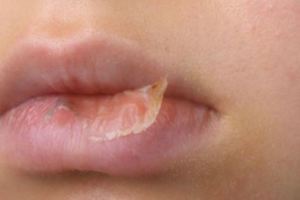 猛擦護唇膏嘴唇卻「越來越乾」…　日醫生指出：左右來回塗做法是錯的！