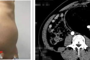 一男子9斤重肚腩減肥減不掉一查病因嚇一跳