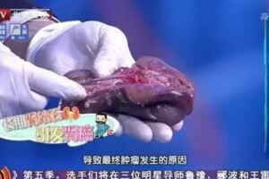 很多結石都是「吃」出來的！這些不良飲食習慣你中招了嗎？