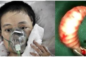 「爸爸，我活不成了，快死了！」22歲女孩臉部潰爛，醫生竟取出200多條蛆蟲！死因讓人不寒而慄！