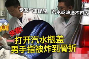 打開汽水瓶蓋　男手指被炸到骨折