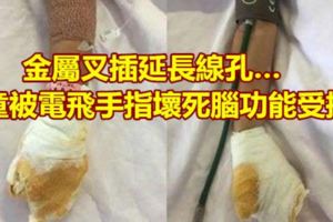 金屬叉插延長線孔…童被電飛手指壞死