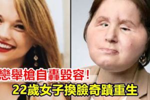 失戀舉槍自轟毀容！22歲女子換臉奇蹟重生