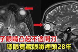 女子眼睛凸起不適開刀隱眼竟藏眼瞼裡頭28年