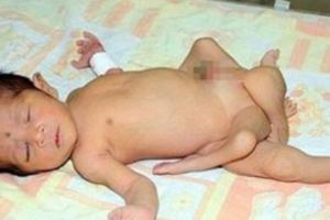 產婦順利生下男嬰，令人震驚的是他有6條腿，「凶手」竟是父親