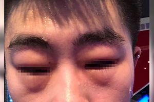 健身房毛巾擦汗！他臉腫呼吸困難前員工：真的別用