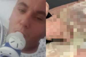 電子菸口袋裡爆炸！他蛋蛋險被炸飛胯下、大腿全燒傷!