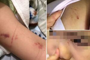 孩試讀5天換一身瘀傷幼兒園竟回「沒收錢還想怎樣？」