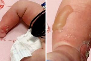 3月大男嬰洗澡被燙傷！右腿大水泡、紅腫破皮…肇事保母僅「這樣回應」網氣炸！