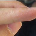 檢查看看，你的掌心或手指側面也會長出「西米露」嗎？竟然是這種疾病，真的不能輕忽啊！