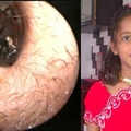 這個12歲的少女每天都會從耳朵冒出十隻「活螞蟻」！醫生掏出了1000多隻後，驚訝地發現她體內竟然是…