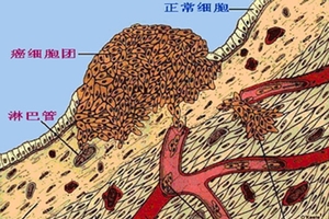 請多喝熱開水：因為癌像感冒一樣普遍： 日本新發現殺癌細胞的方法，原來就是常喝這個！！