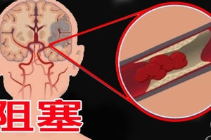 99％的人不知道，吃這水果，才能真正「預防中風死亡」！轉載一次救人一命！！