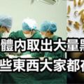 女子體內取出大量黑蟲，與「這個愛好」有關！沒想到「這些東西」大家都在吃！