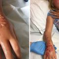 7歲小女孩開心挑戰「漢娜手繪」卻發現手癢癢的，結果「整隻手爛掉」再也無法復原！