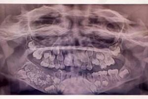 印度7歲男孩下顎腫脹，醫生從他口中拔出了526顆牙